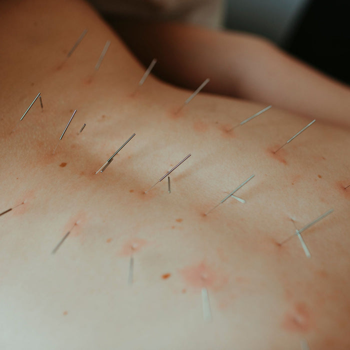 Sports Acupuncture