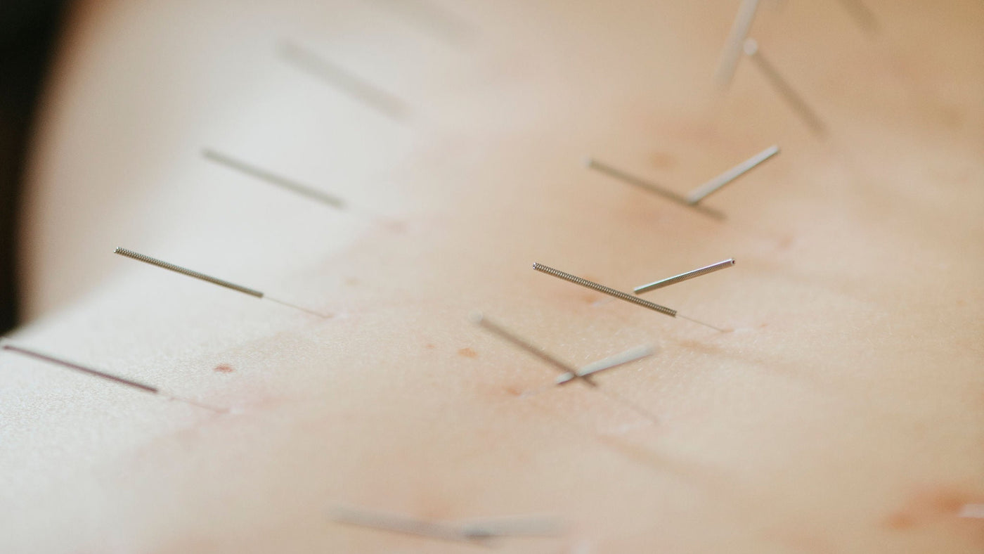 Sports Acupuncture
