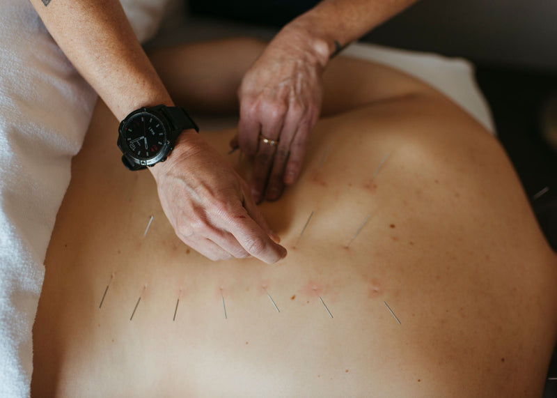 Acupuncture