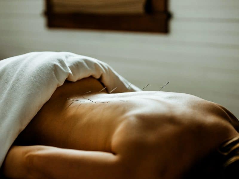 Acupuncture