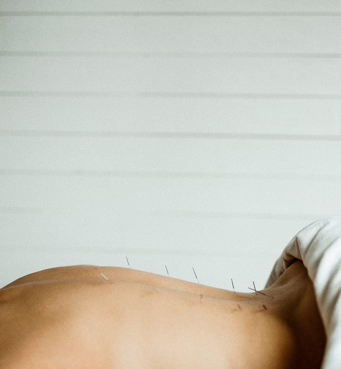 Traditional Chinese Medicine Acupuncture