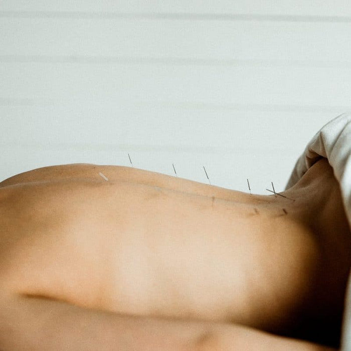 Traditional Chinese Medicine Acupuncture