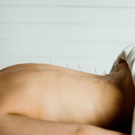 Traditional Chinese Medicine Acupuncture