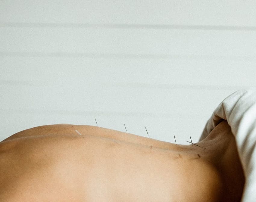 Traditional Chinese Medicine Acupuncture