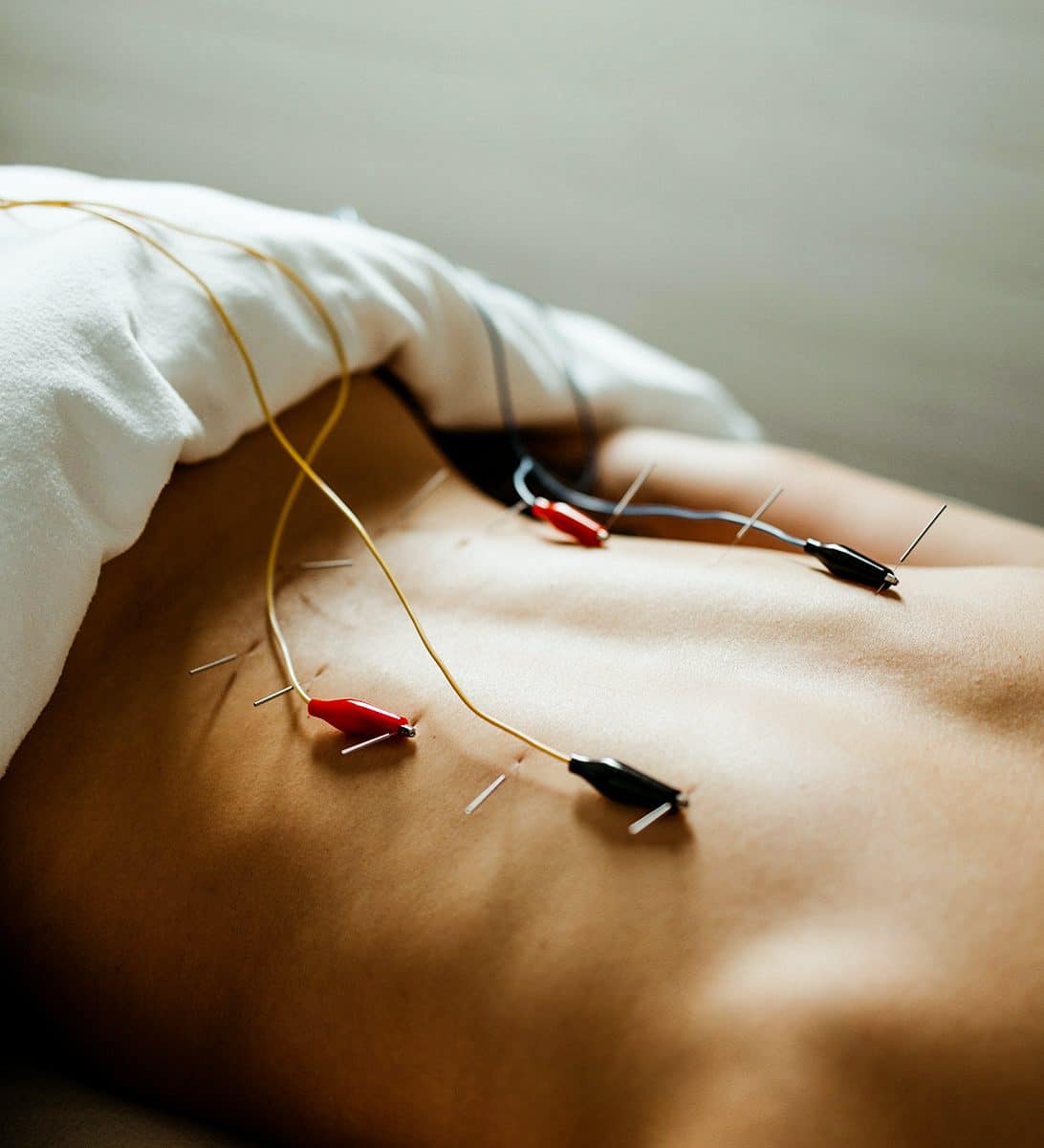 Electrical Stimulation