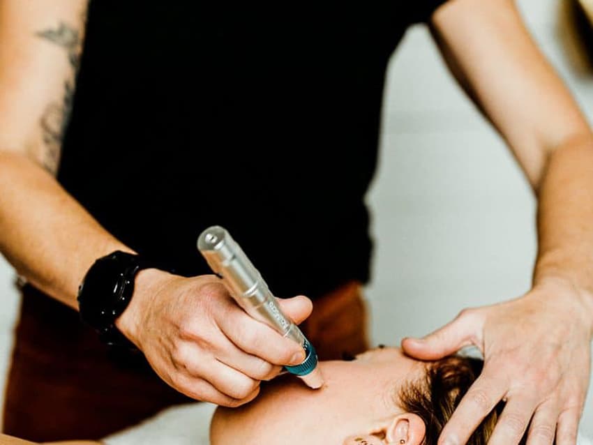Microneedling