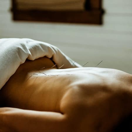 Sports Acupuncture