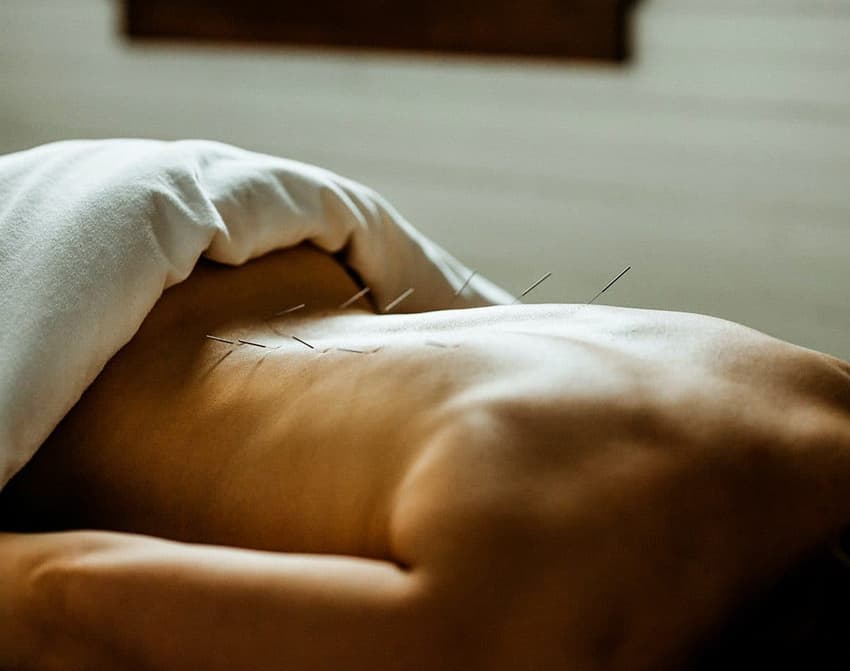 Sports Acupuncture